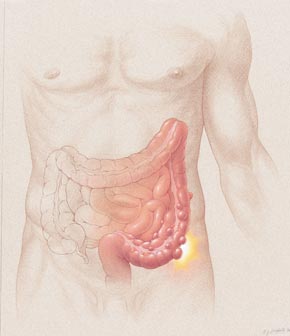 Diverticulitis_diagram