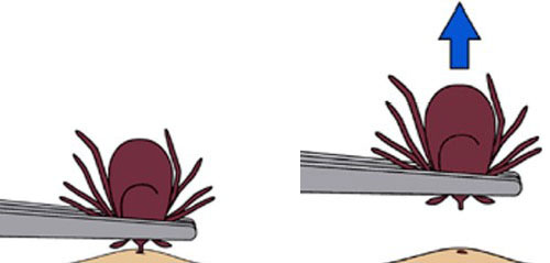 Tick Removal a How-to From the CDC