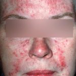 Rosacea - papules and pustules