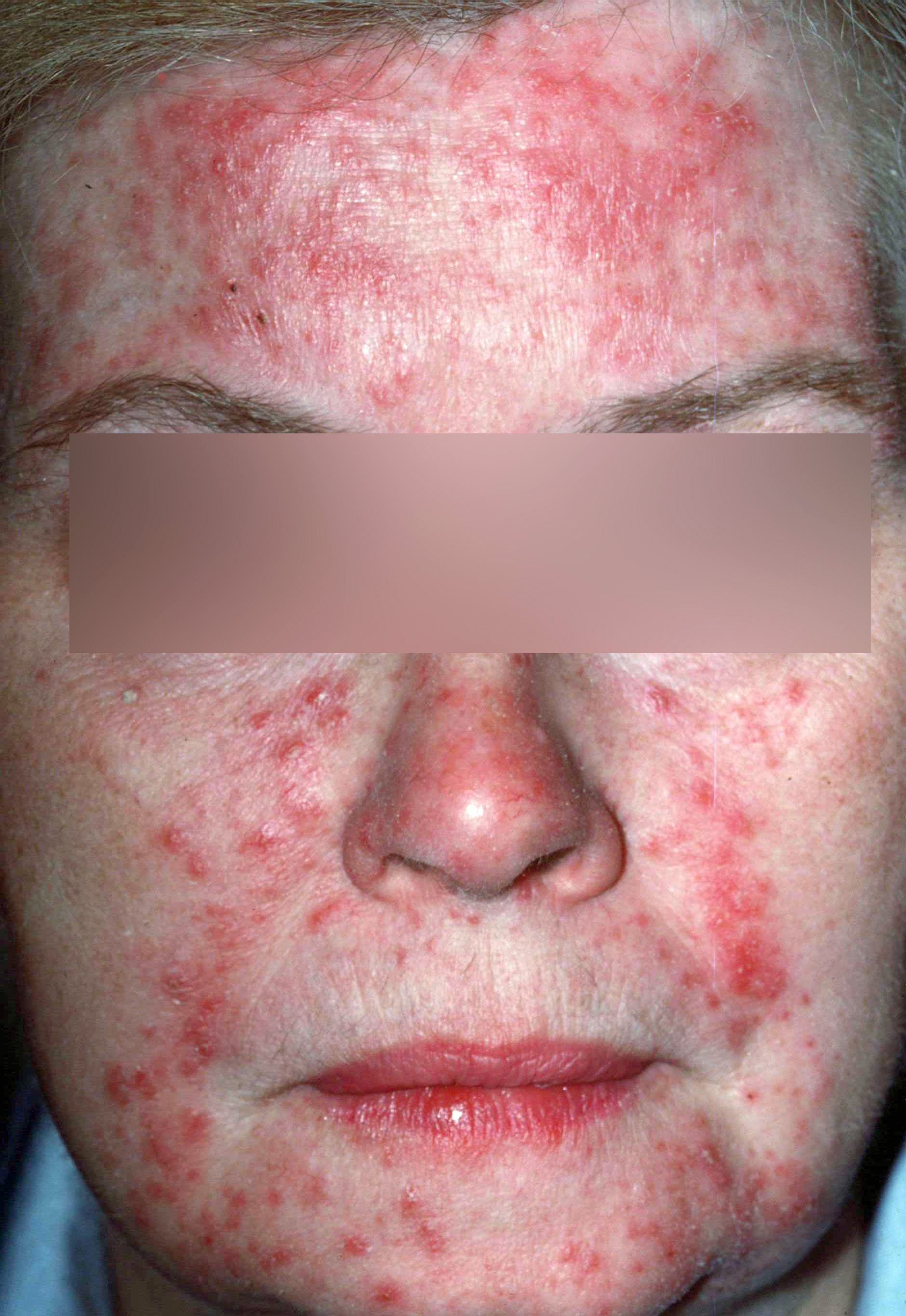Rosacea - papules and pustules
