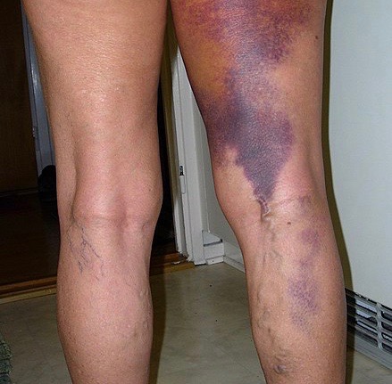 Bruise on Back of Leg Going Down to the Knee 2